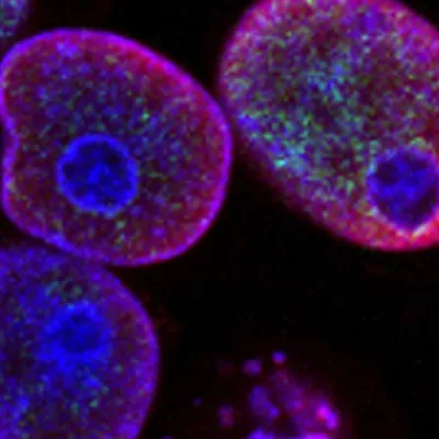Human colorectal cancer cells stained with multiple colors of dye in order to study a cancer therapy.